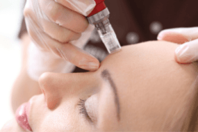 Microneedling-Masterclass-Training-Courses-Cosmetic-Courses